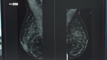 Cancro al seno, Health Triage sviluppa uno screening con I.A.