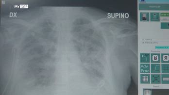 Polmonite interstiziale, soggetti fragili più a rischio vita