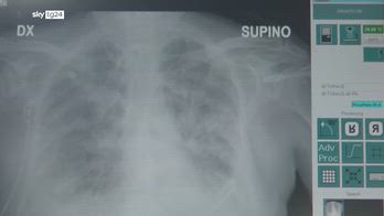 Polmonite interstiziale, di cosa si tratta e chi è a rischio