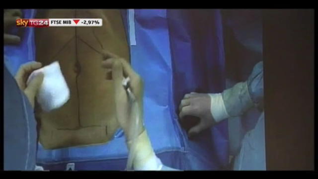 Primo espianto d'organi al mondo eseguito da robot