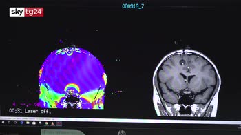 ERROR! Napoli, tumori cerebrali nei bambini distrutti con laser
